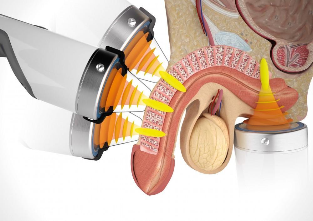 Shockwave Therapy