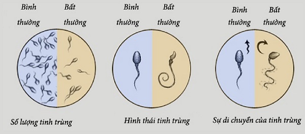 Sốc Với Tỷ Lệ Thanh Niên Đối Mặt Với Nguy Cơ Vô Sinh Do Tinh Trùng Yếu 2 image002 8