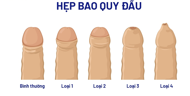 CẮT BAO QUY ĐẦU BẰNG PHƯƠNG PHÁP NÀO LÀ TỐT NHẤT? 2 screenshot 1756692298