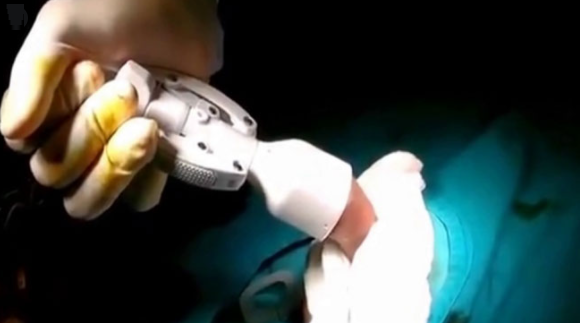 CẮT BAO QUY ĐẦU BẰNG PHƯƠNG PHÁP NÀO LÀ TỐT NHẤT? 3 video cat bao quy dau