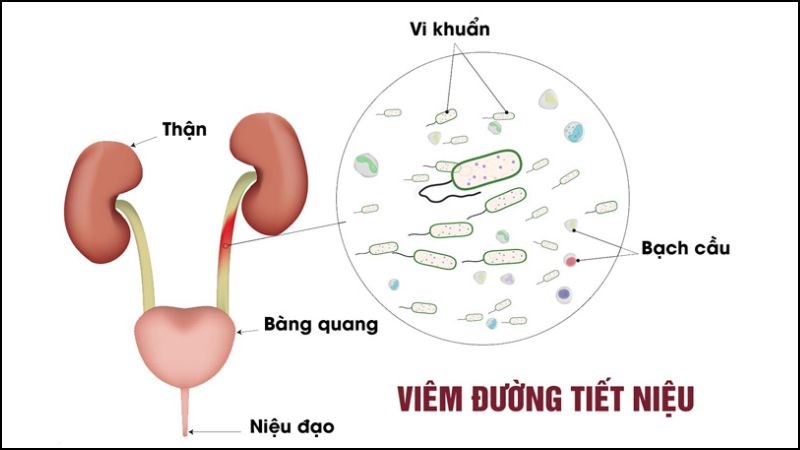 bi viem duong tiet nieu co quan he duoc khong rui 800x450 1