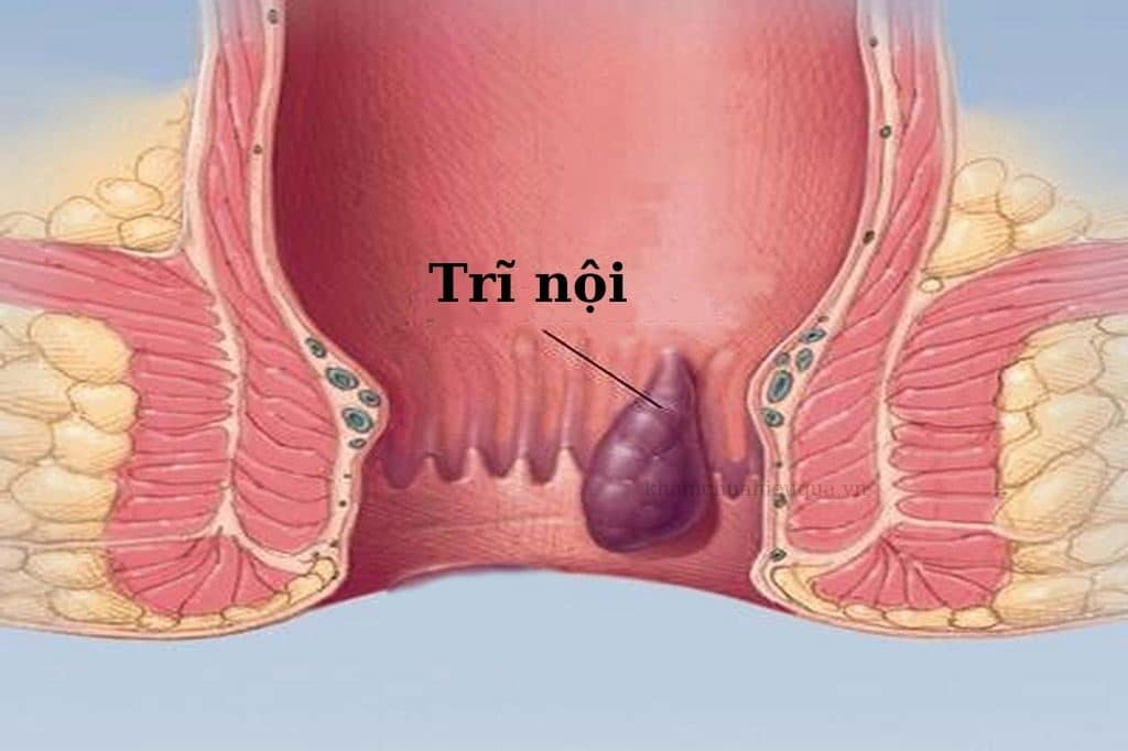 Mách Bạn 7 Cách Phòng Ngừa Bệnh Trĩ Tái Phát Hiệu Quả Nhất 3 image 4