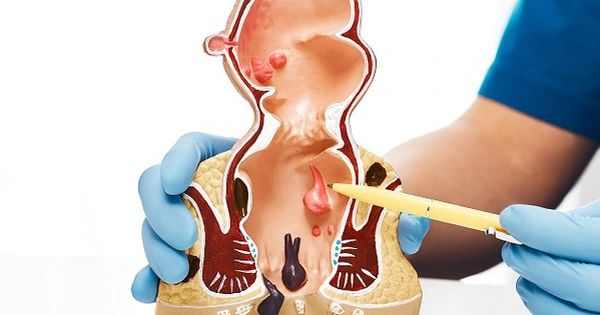 Mách Bạn 7 Cách Phòng Ngừa Bệnh Trĩ Tái Phát Hiệu Quả Nhất 4 image 5