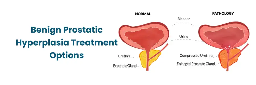 Treatment Options for BPH: Medication, Laser, Surgery 3 image 21