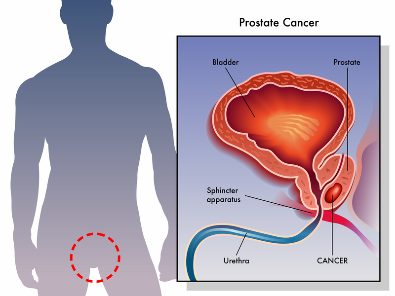 prostrate cancer and ed