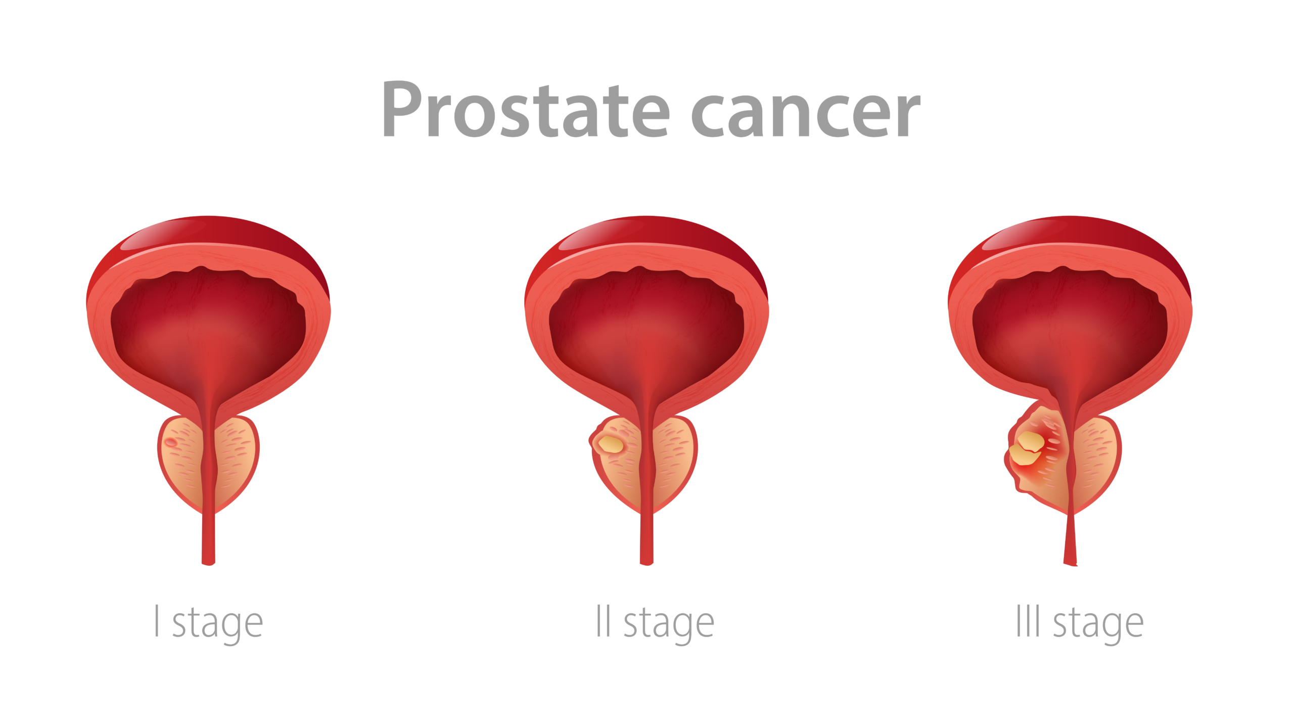 Benefits of PSA prostate cancer screening more than estimated, especially for blacks