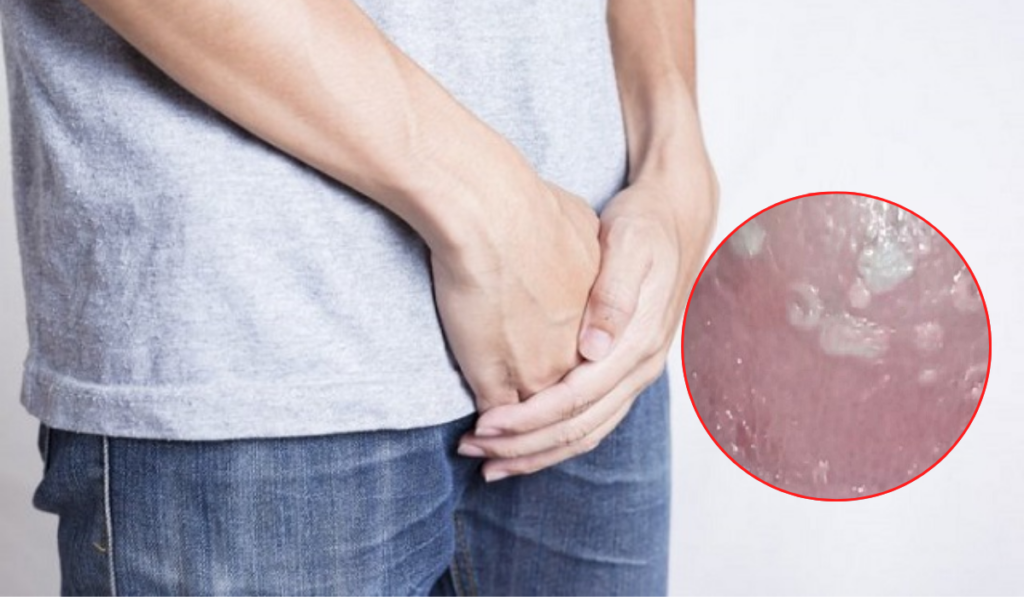 Vaginal yeast infections: It’s about more than just itching! 2 image 36