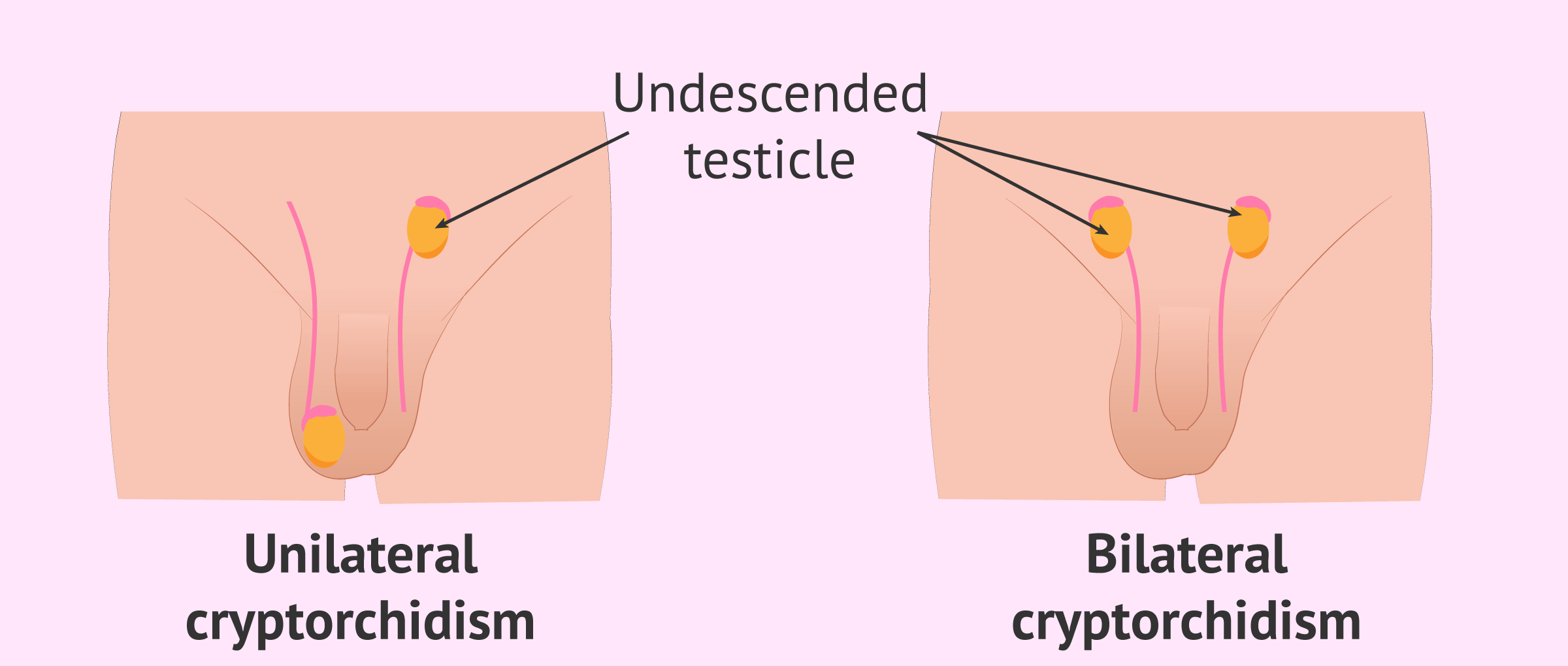 Undescended Testicle: Causes, Signs, and Medical Treatment 3 image 51