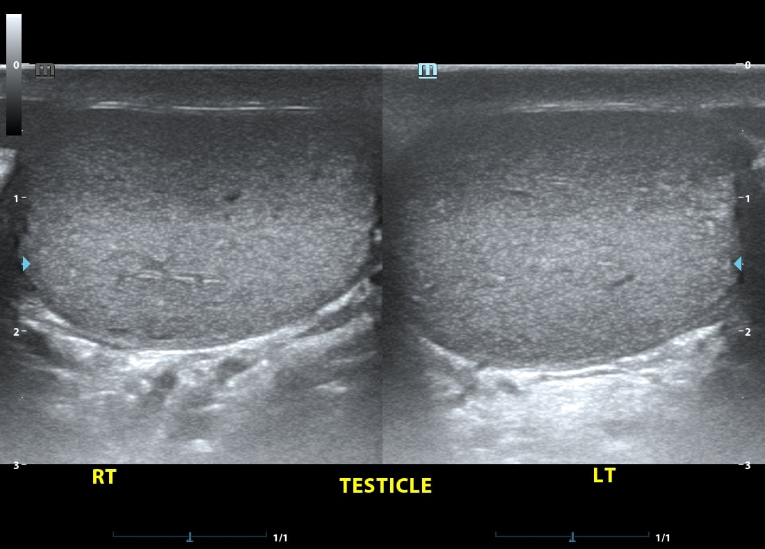 When Should Men Get a Testicular Ultrasound? 3 image 63