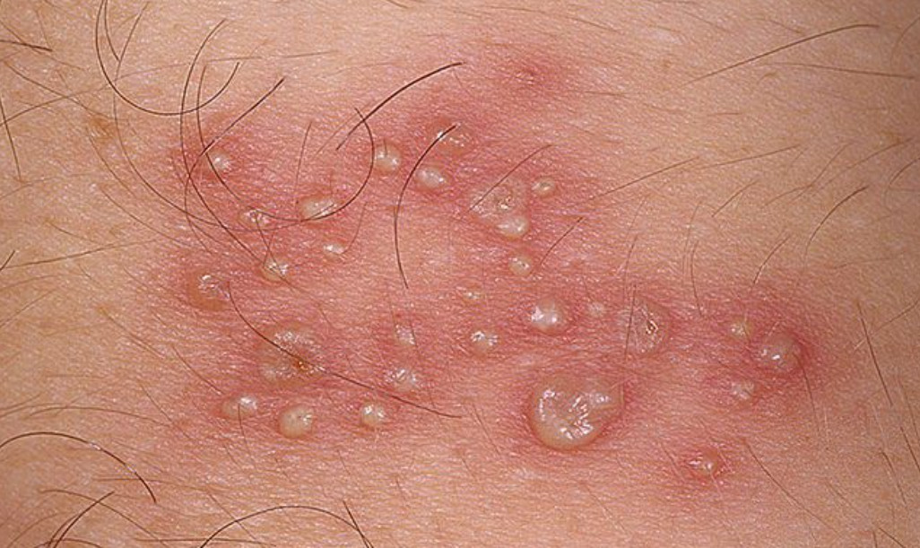 Genital Herpes: Causes, Symptoms, and Treatment