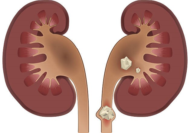 Kidney Stones: Causes, Symptoms, Diagnosis, and Evidence-Based Medical Treatment