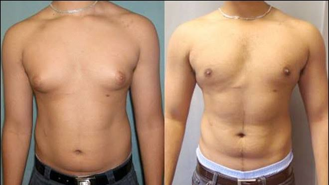 When Do Men with Gynecomastia Need Medication and When is Surgery Required?