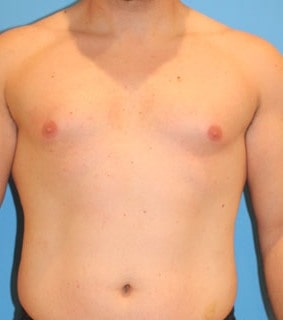 When Do Men with Gynecomastia Need Medication and When is Surgery Required? 3 image 8